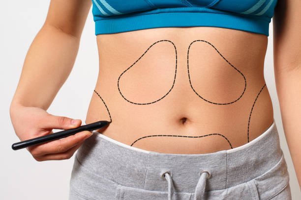 Liposuction in Turkey